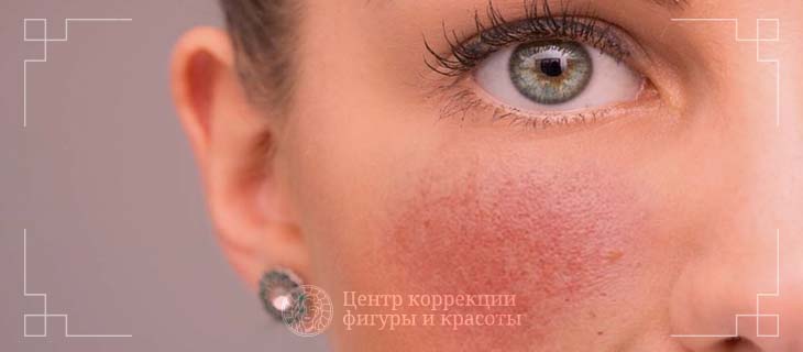 ЭЛОС - перспективное решение для лечения пигментации и купероза